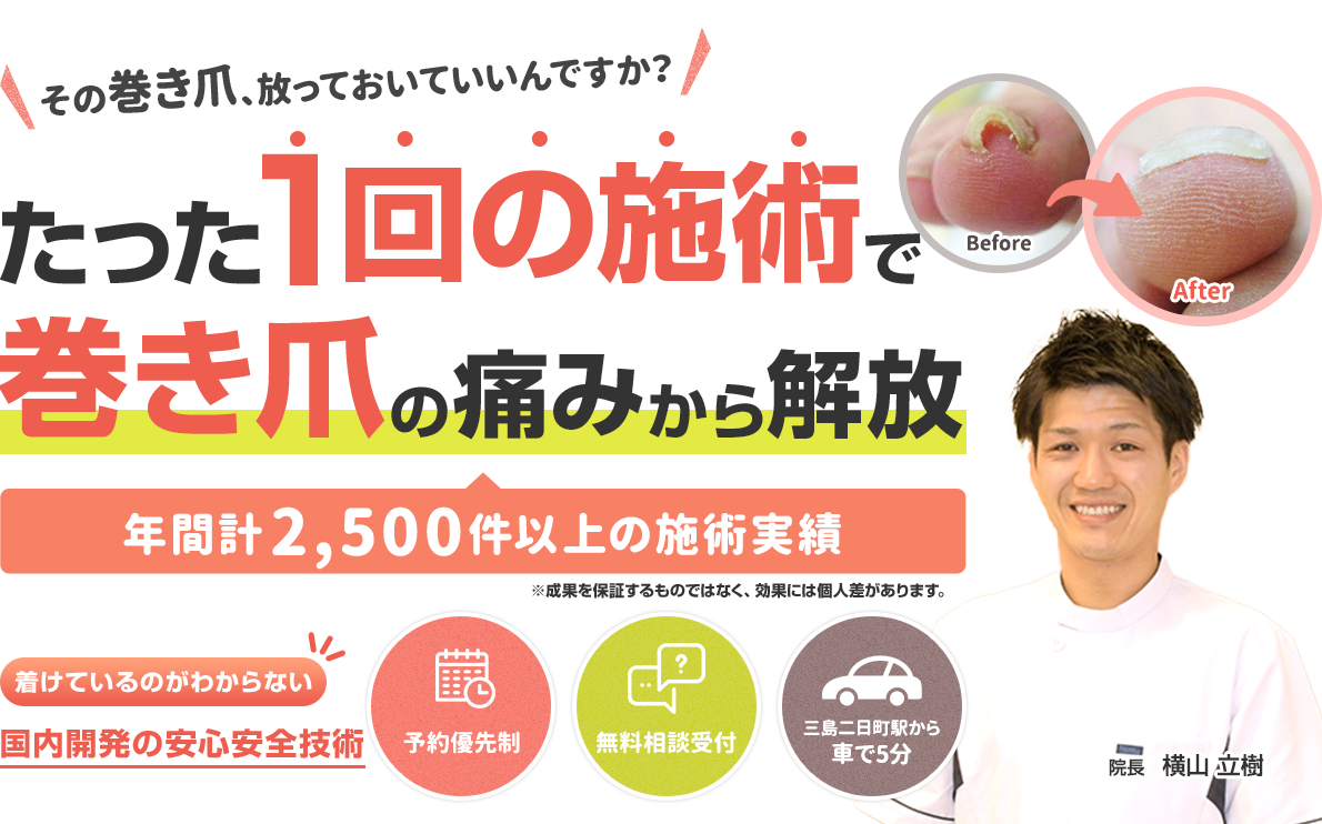 たった1回の施術で巻き爪の痛みから解放