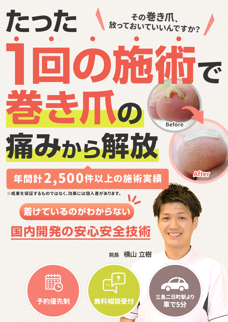 たった1回の施術で巻き爪の痛みから解放